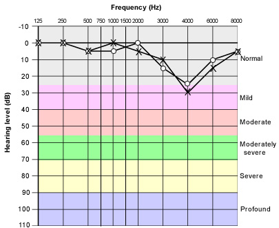 Diagram of Mild High-Frequency loss